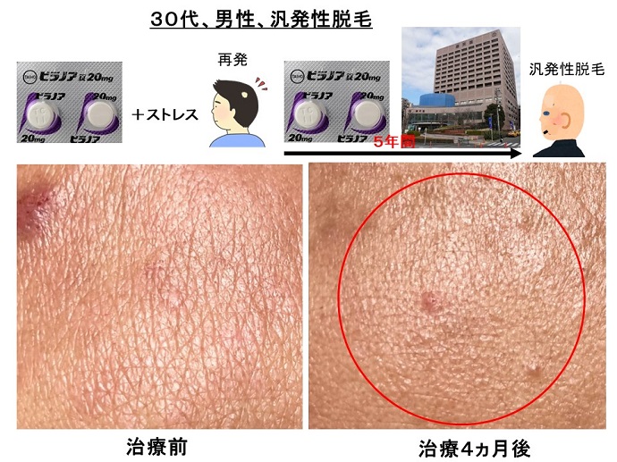 円形脱毛症　病院